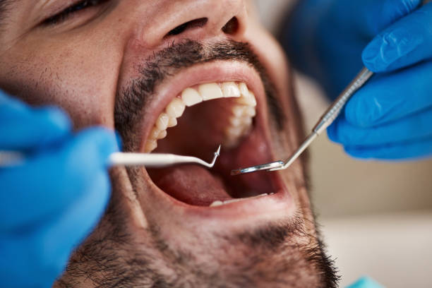 Best Emergency Tooth Extraction in Rutherford, TN